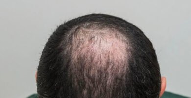 Alopecia androgénica en hombres