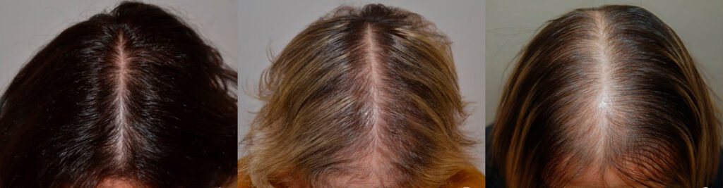 Alopecia en mujeres: alopecia androgenetica femenina