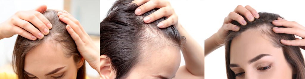 Alopecia en mujeres: alopecia efluvio telógeno femenina