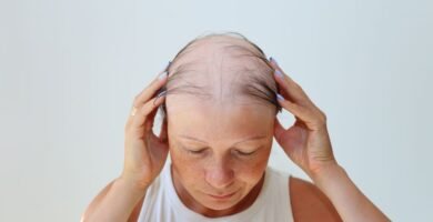 Alopecia Mujeres