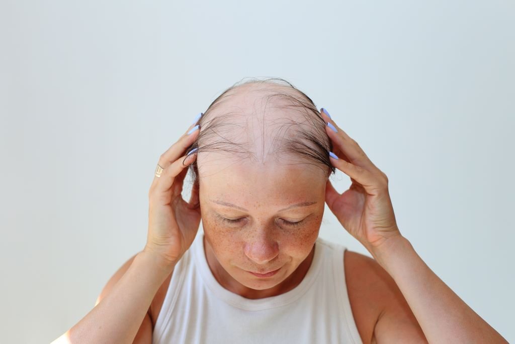 Alopecia Mujeres