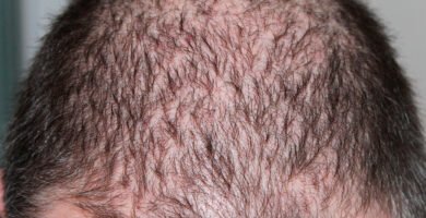 alopecia hombres